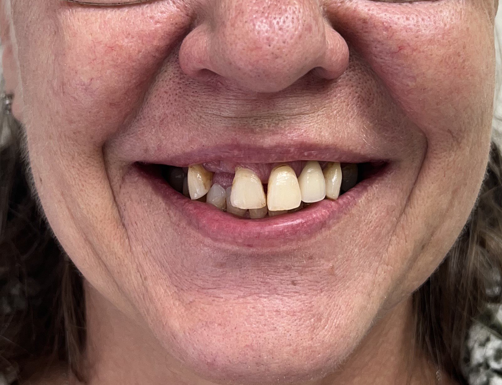 All-on-X implants - Full mouth restoration