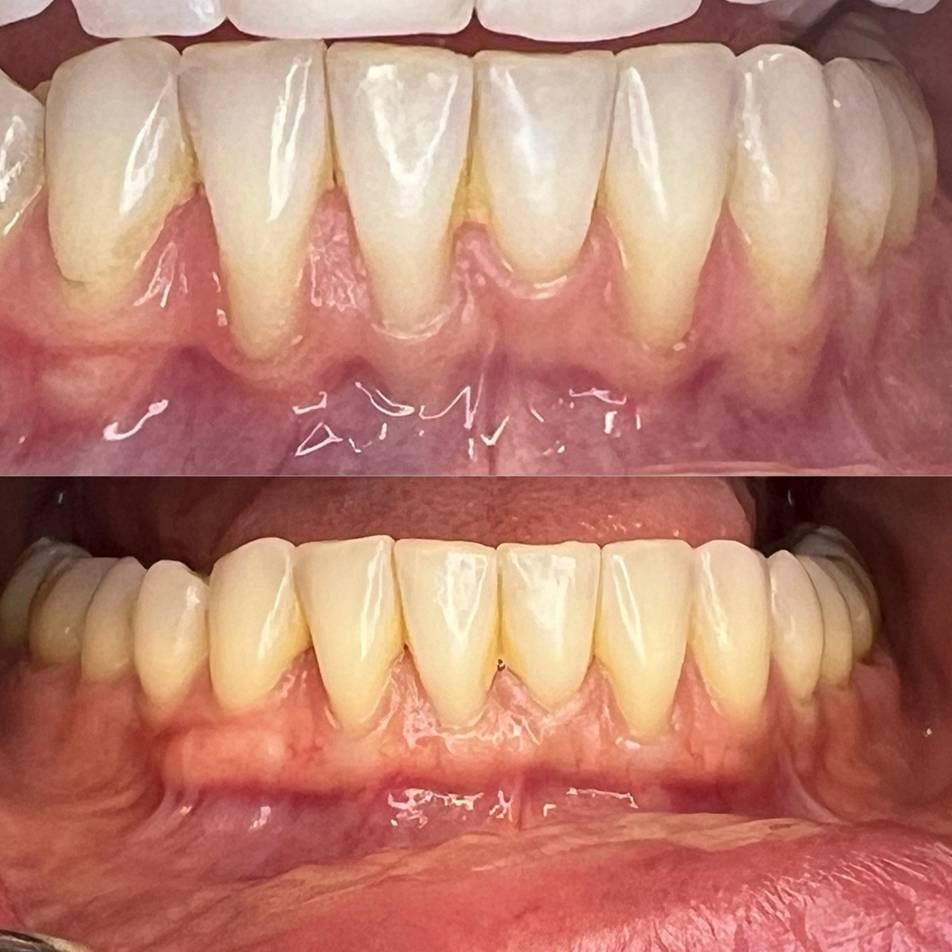 Periodontics - Gum Graft - Before & After
