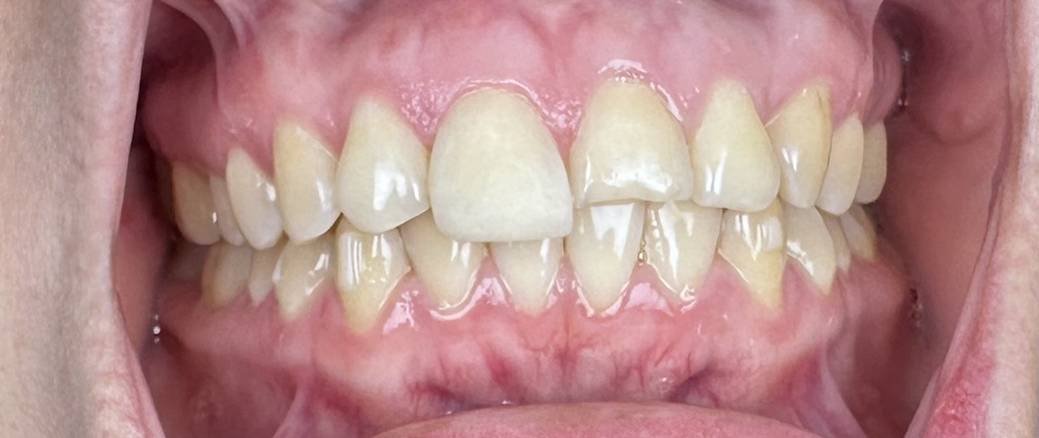 Cosmetic Bonding - Composite Veneer - Before