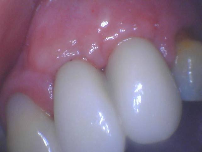 Implant Placement & Restoration - After