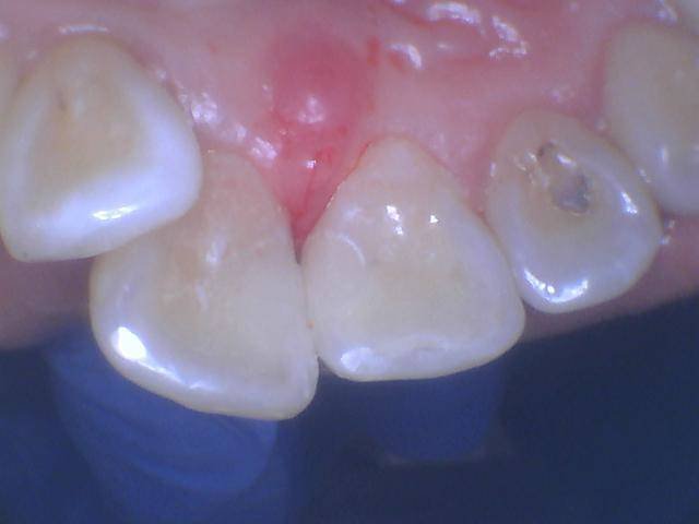 Tooth Colored Anterior Fillings - After
