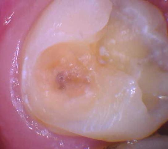 Tooth Color Posterior Filling - Before