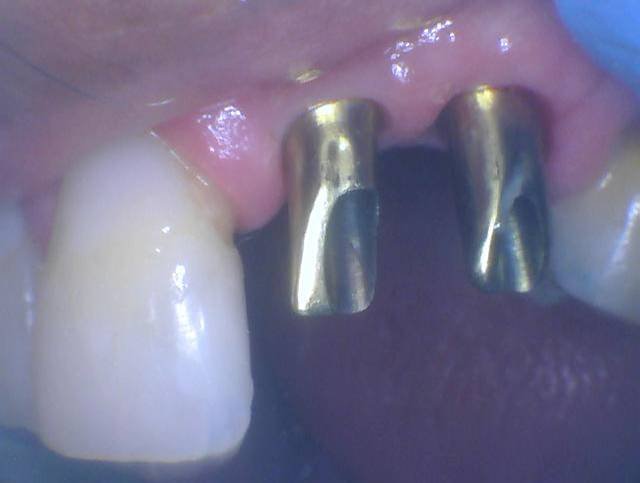 Implant Placement & Restoration - Before