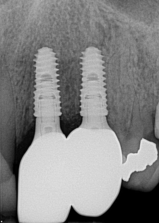 Implant Placement & Restoration - After