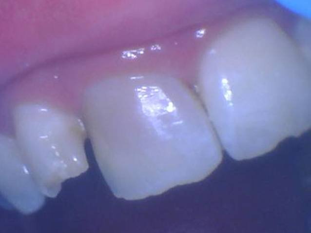 Teeth Whitening - Internal Bleaching - Before