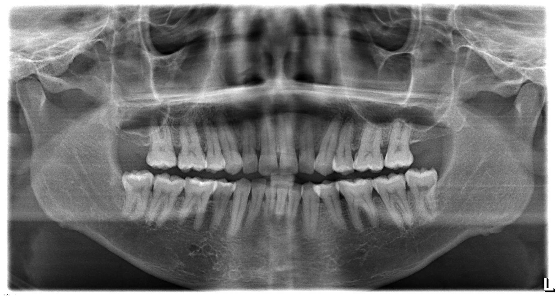 3rd molar extraction - Before