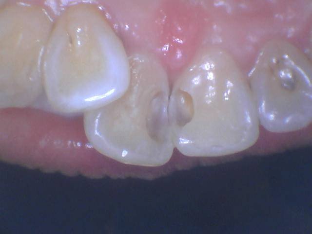 Tooth Colored Anterior Fillings - Before