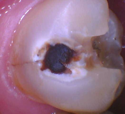 Tooth Color Posterior Filling - Before