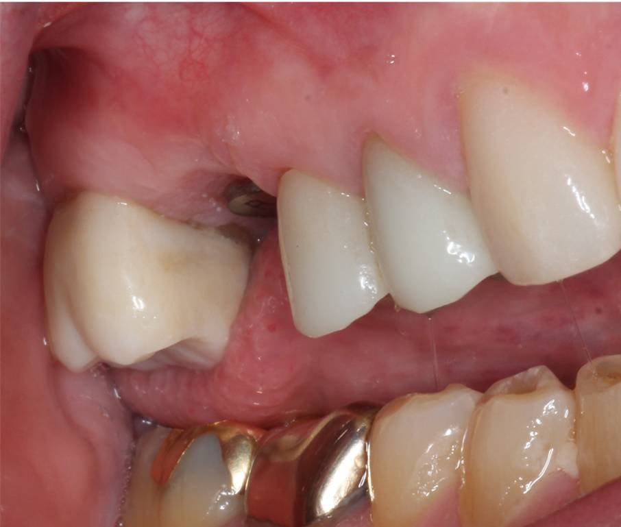Implant Placement & Restoration - Before