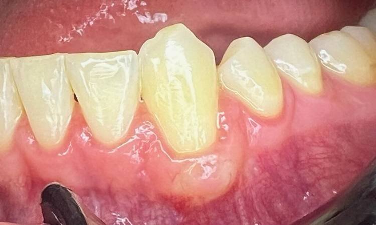 Periodontics - Gum Graft - After