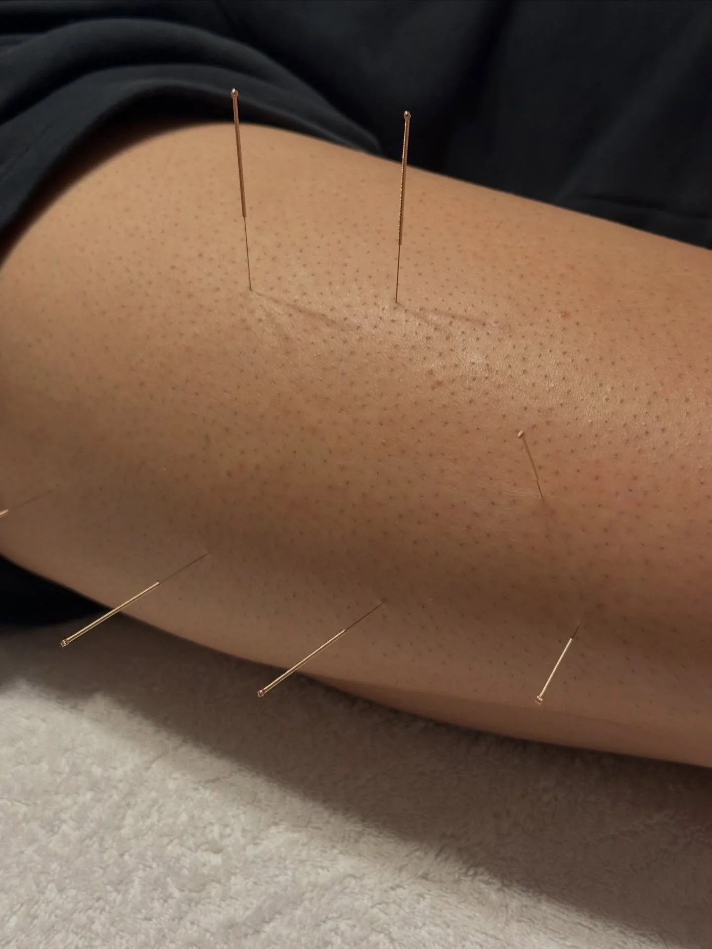 Ever wondered how dry needling actually works? 💉

Dry needling is a clinical technique where a fine, sterile needle is inserted into tight or overactive muscle bands (known as trigger points).

The purpose is to release muscle tension, reduce pain, 