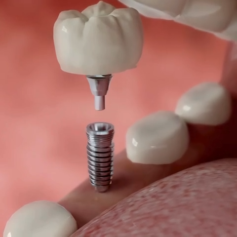 زراعة الأسنان في حياة دنت