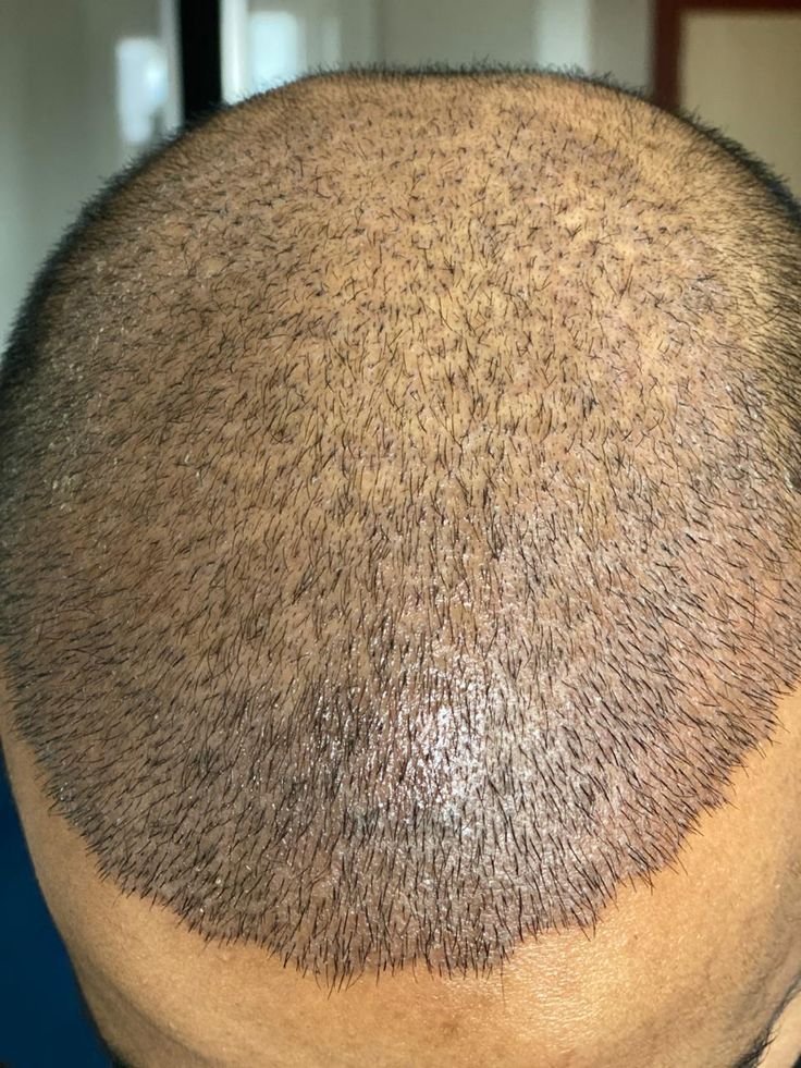زراعة الشعر في تركيا والسعودية ومصر: مقارنة شاملة ولماذا تتفوق تركيا؟