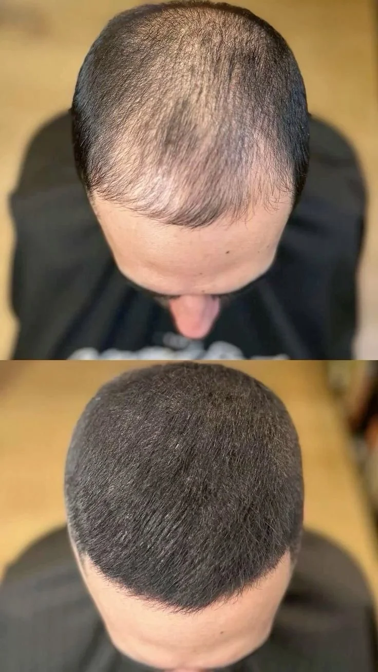    كم تكلفة زراعة الشعر في تركيا 2026؟ الدليل الكامل للأسعار