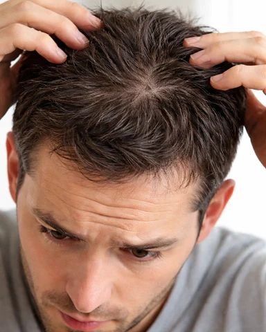 هل تدوم نتائج زراعة الشعر مدى الحياة؟ كل ما تحتاج إلى معرفته