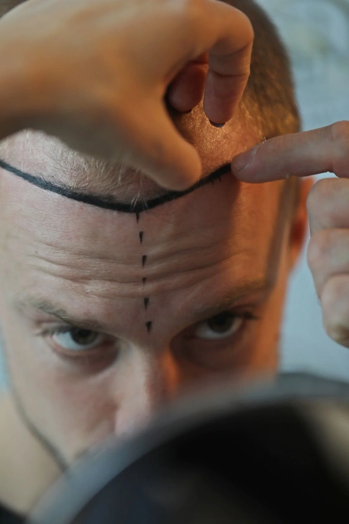 كم عدد البصيلات التي أحتاجها لزراعة الشعر؟ دليل شامل حسب درجة الصلع
