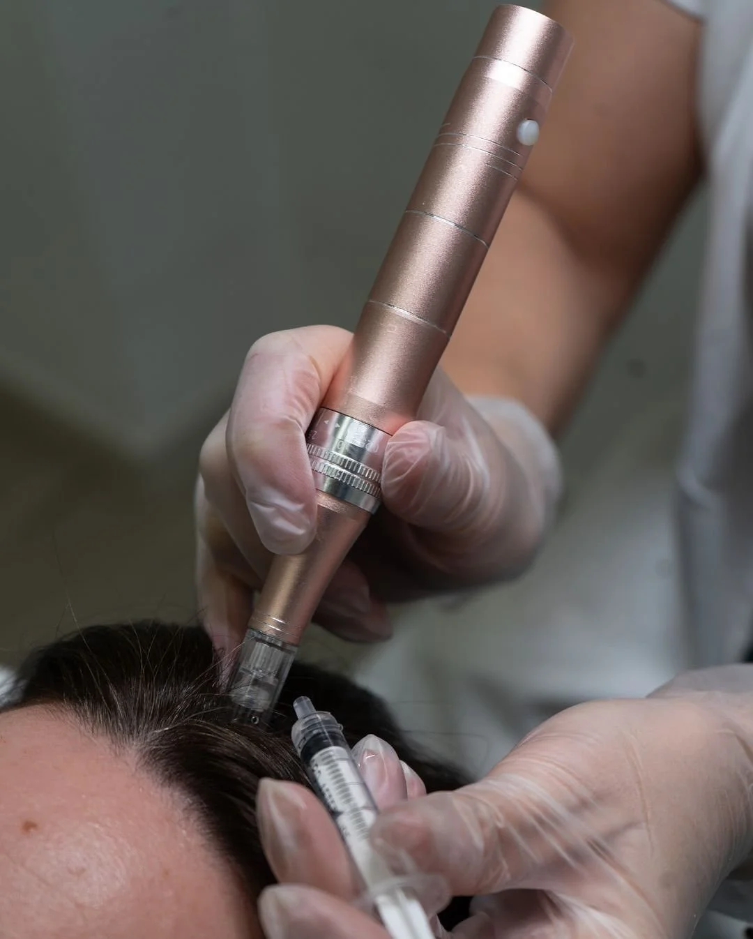 زراعة شعر النساء في تركيا: أحدث التقنيات والنتائج وكل ما يجب معرفته