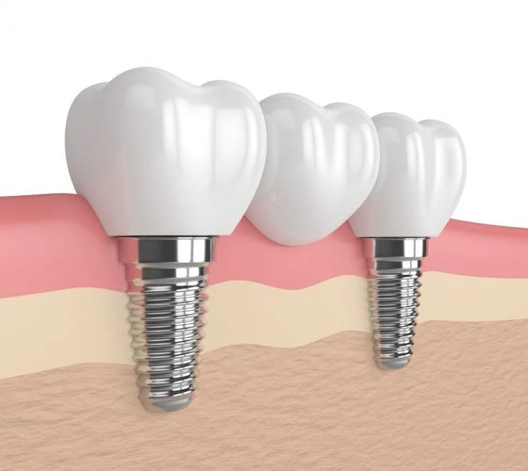   Straumann أم Nobel Biocare أم Megagen    مقارنة شاملة بين أفضل أنواع  زراعة الأسنان 2026