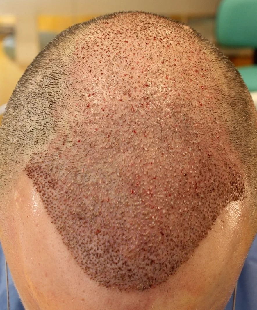 زراعة الشعر في تركيا أم السعودية؟ مقارنة الأسعار والنتائج والباقات 2026