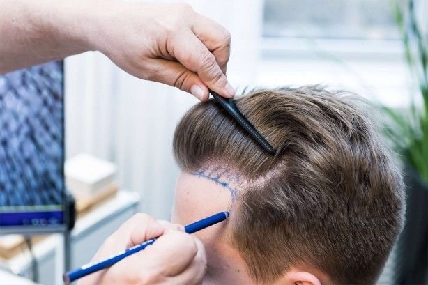 زراعة الشعر بتقنية أقلام تشوي: دقة ونتائج طبيعية متقدمة