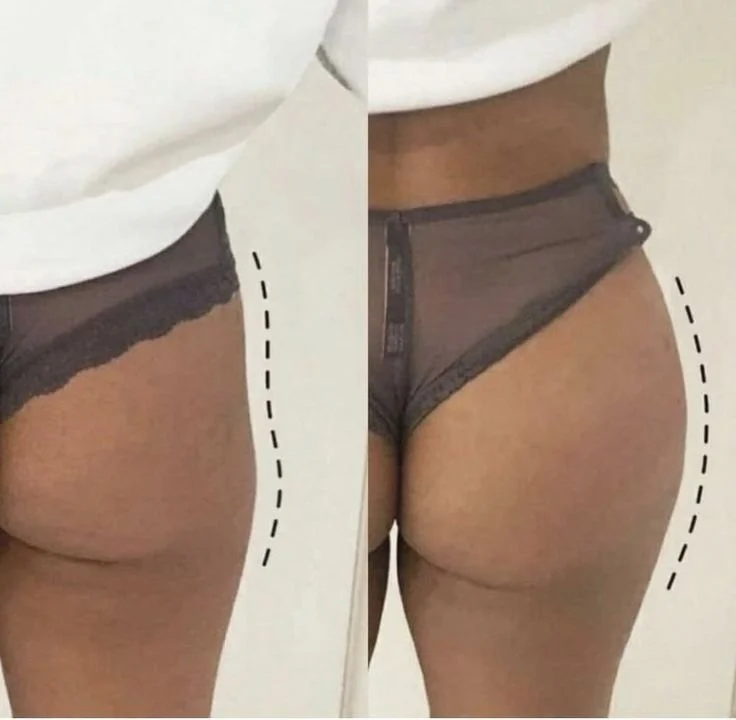 رفع وتجميل المؤخرة: الحلول التجميلية لاستعادة التناسق والثقة