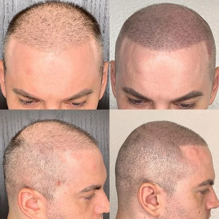 هل زراعة الشعر حل فعّال لعلاج الصلع؟ كل ما تحتاج معرفته