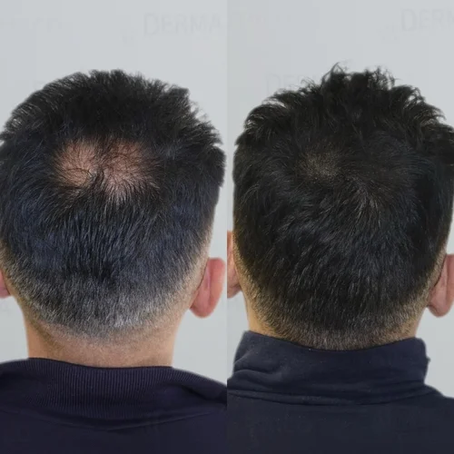 زراعة الشعر حياة دنت