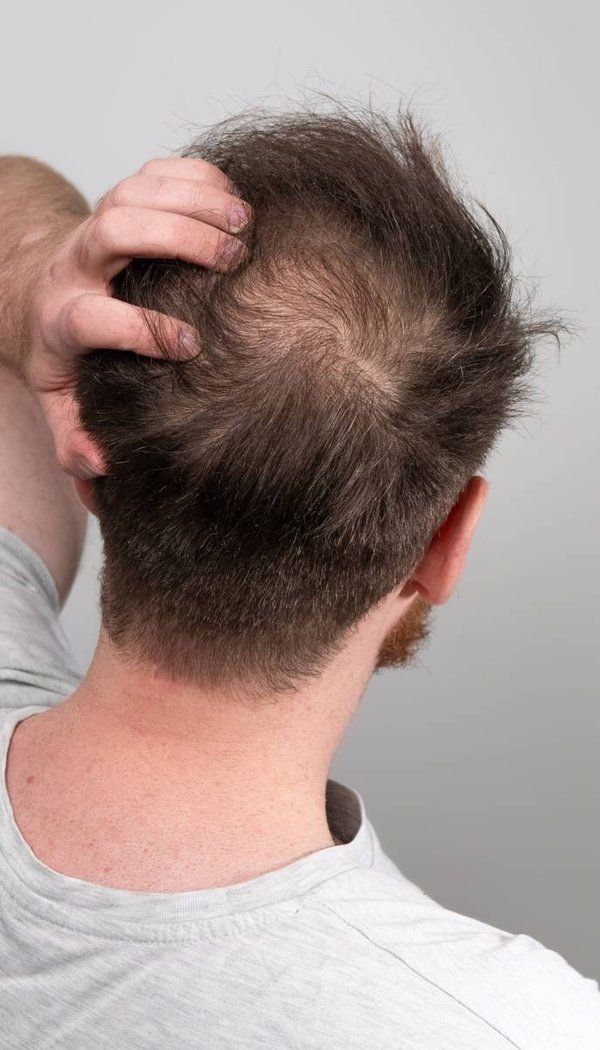 الفرق بين زراعة الشعر في إسطنبول ومصر: الأسعار، الجودة، وأيهما الأنسب لك؟