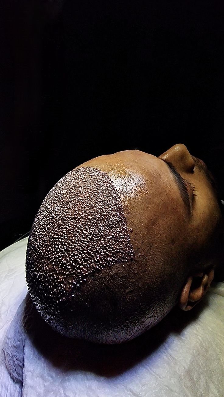 زراعة الشعر بتقنية FUE: الطريقة المثلى لاستعادة كثافة الشعر