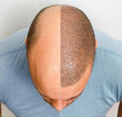 الخلايا الجذعية لزراعة الشعر: الحل المتقدم لاستعادة كثافة الشعر