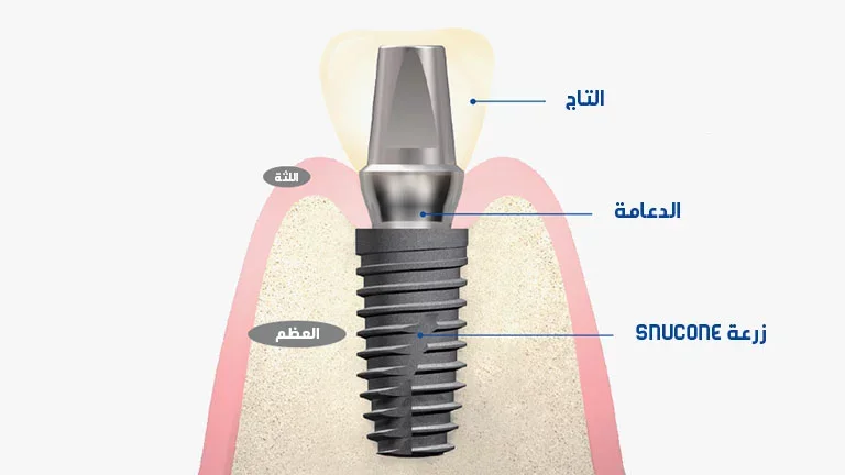 أفضل أنواع زراعة الأسنان | مقارنة التركي والألماني والكوري والسويسري