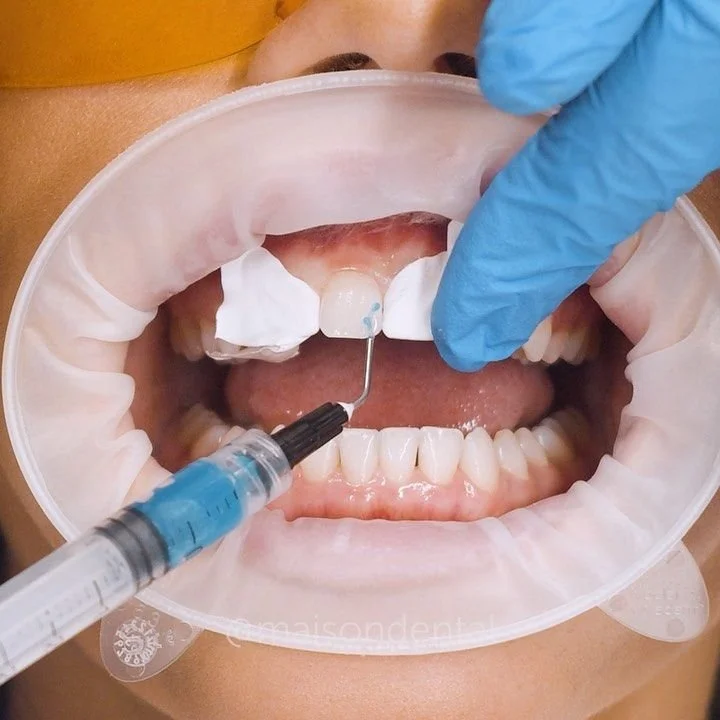 لماذا يعتبر الـ Composite Bonding  ؟