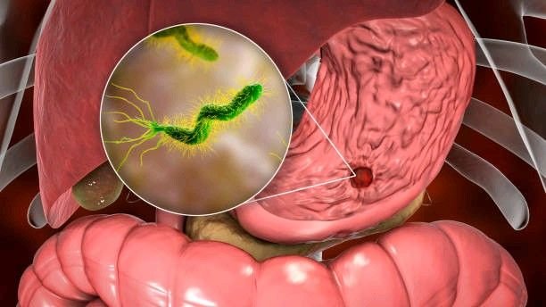 "جرثومة المعدة (H. pylori): الأسباب، الأعراض، طرق العلاج والوقاية"