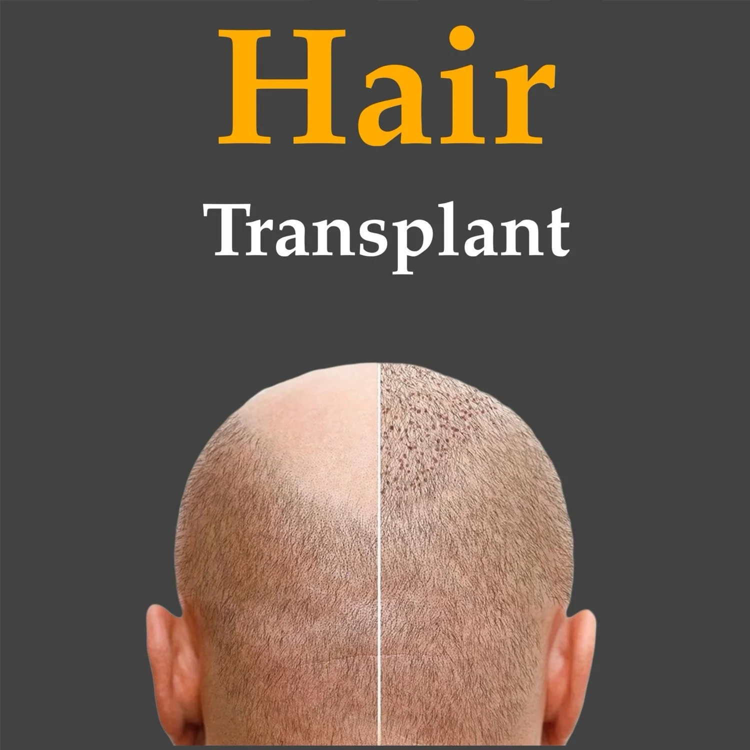 Hair Transplant