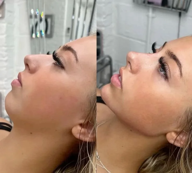 تجميل الأنف غير الجراحي