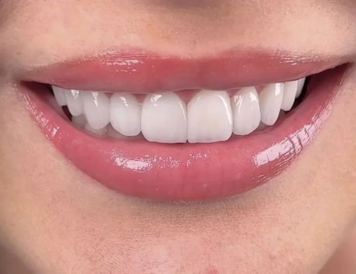 تبييض الأسنان