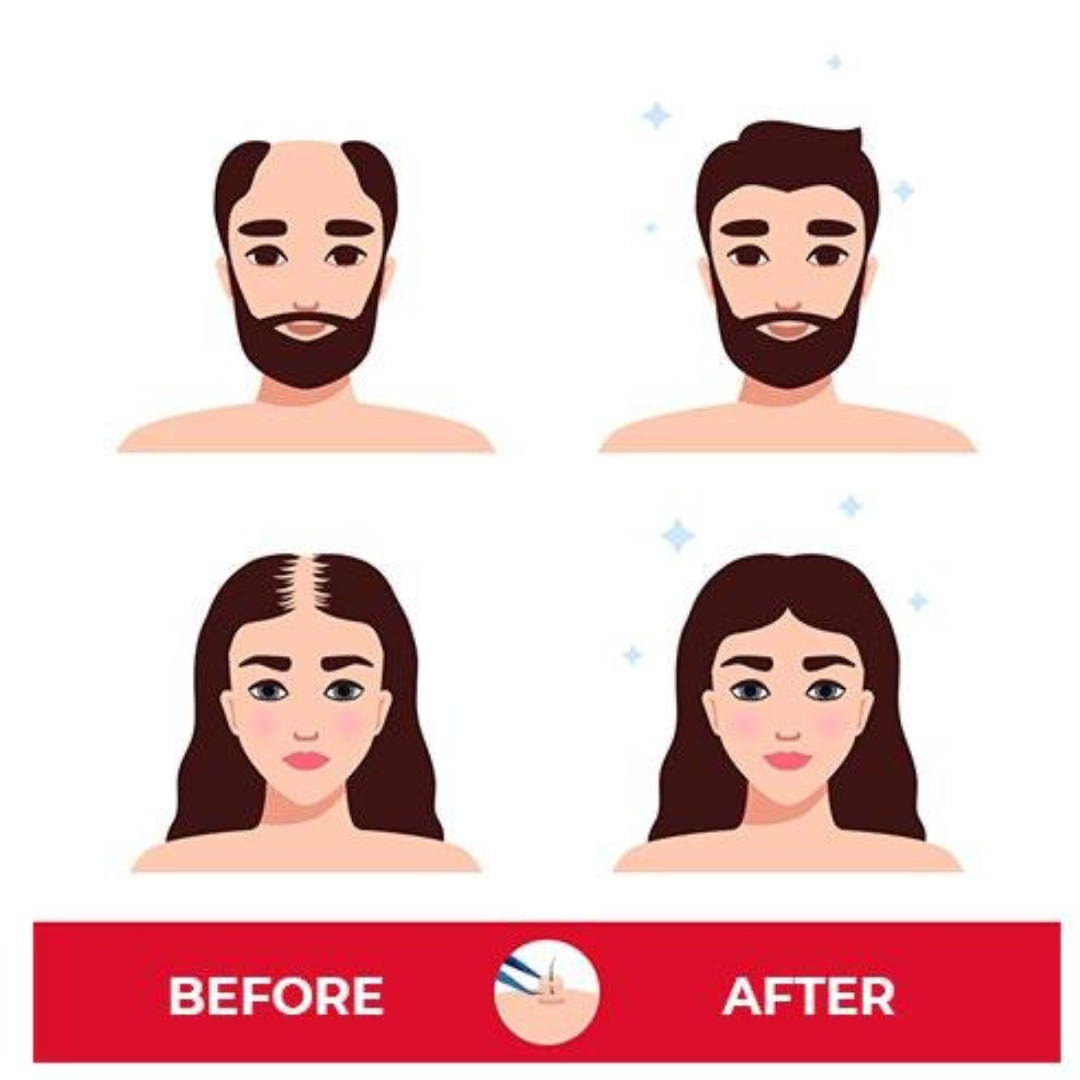 Illustration of before and after hair treatment for men and women. The top row shows a man with balding hair before and fuller hair after. The bottom row shows a woman with thinning hair before and thicker hair after. "Before" and "After" labels are displayed at the bottom.