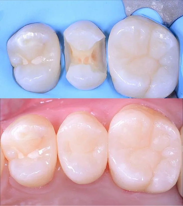 حشوات الأسنان