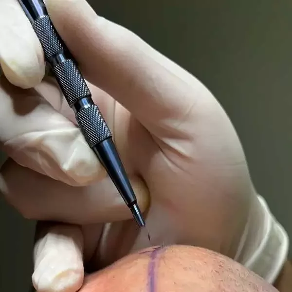 قلم السفير لزراعة الشعر