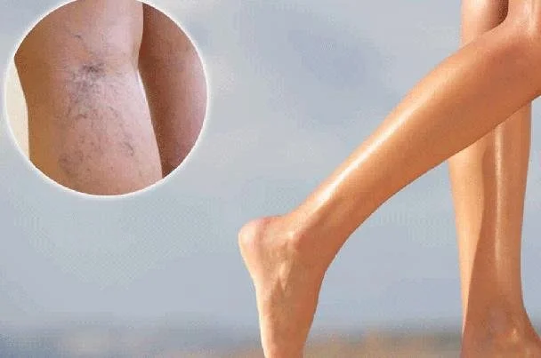 دوالي الساقين