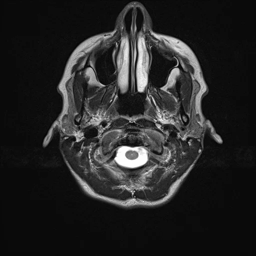 What is an MRI and how does it work?