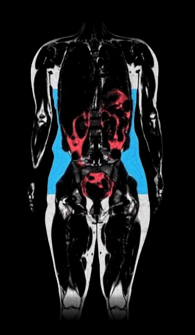 Liver Fat
