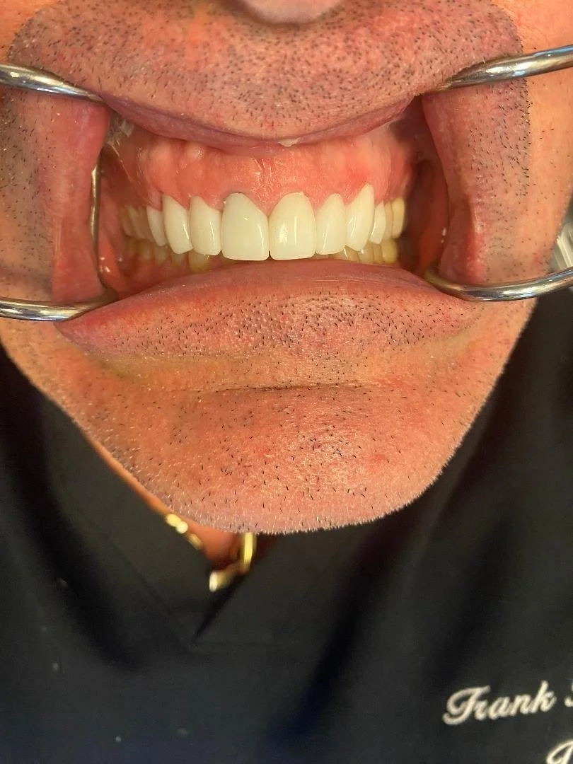 Upper Smile Makeover with Full Zirconia Veneers.jpg