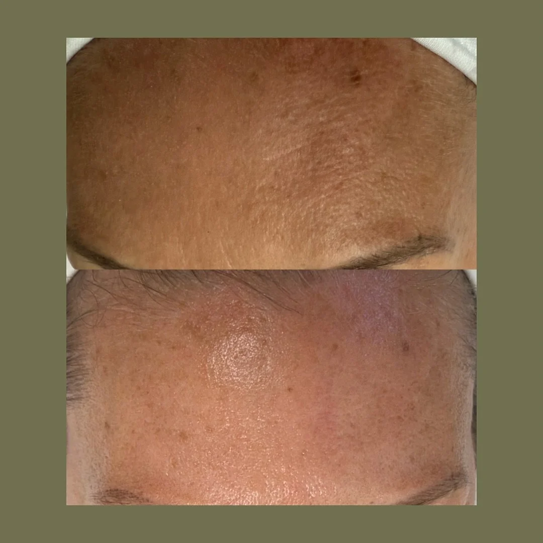 What if we told you this transformation took just 30 minutes? 👀

We specialize in high-quality, medical-grade facials backed by clinical research. Each treatment is fully customized to your skin&rsquo;s needs using advanced techniques and profession