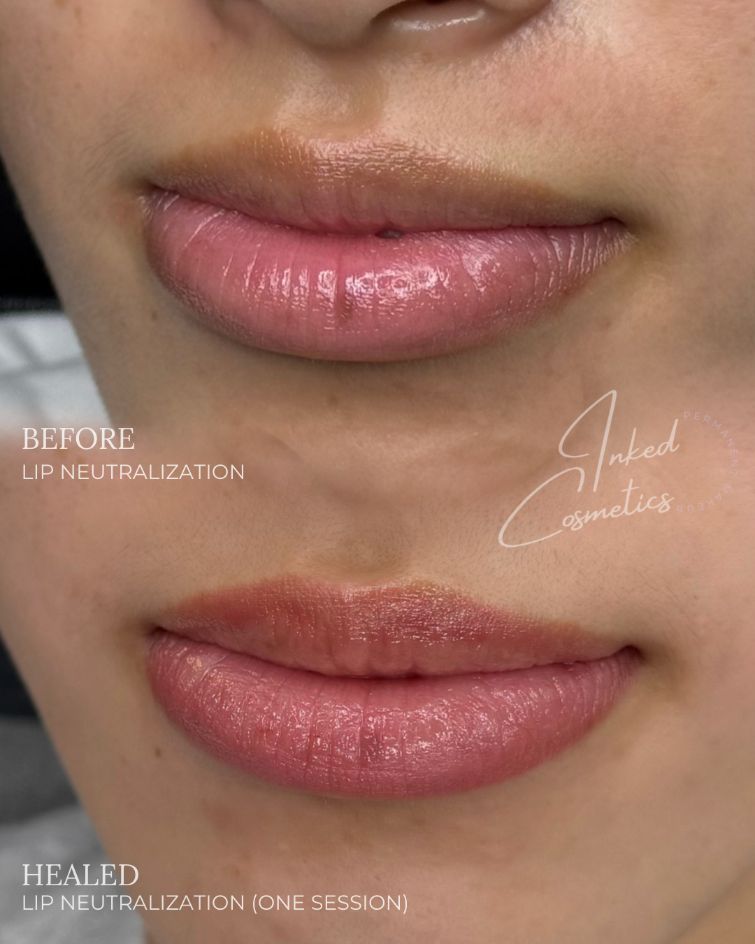 Lip Neutralization - Healed