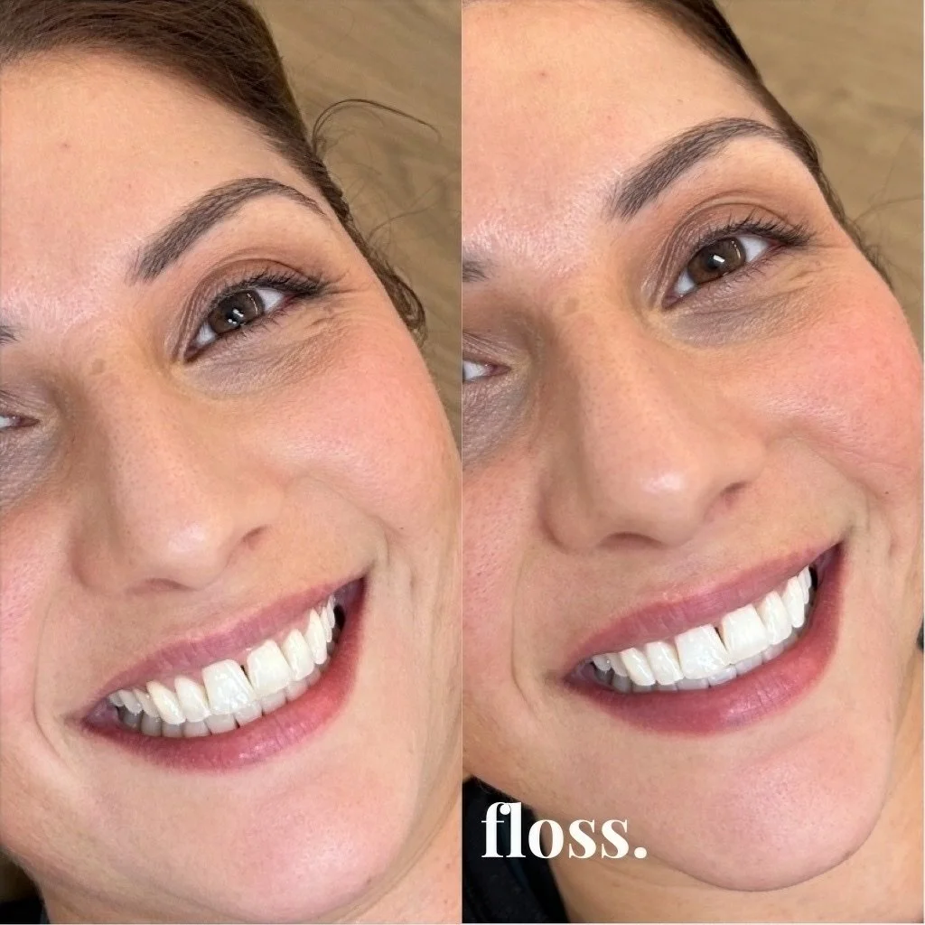 Close-up of a woman's face showing before and after dental cleaning, with the word 'floss' written at the bottom.