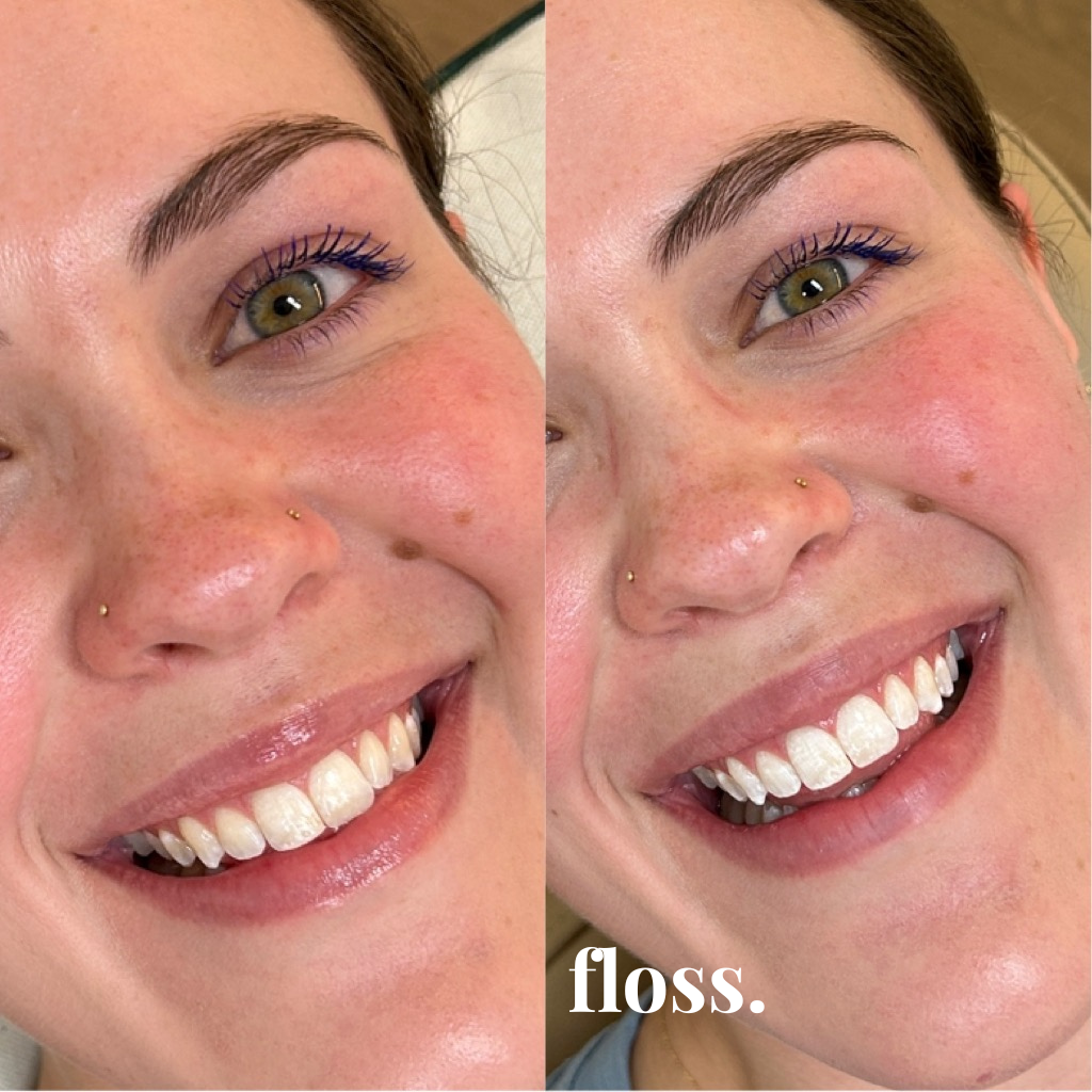 Close-up of a woman's face showing a before and after comparison of her teeth, highlighting a smile with white teeth after flossing.