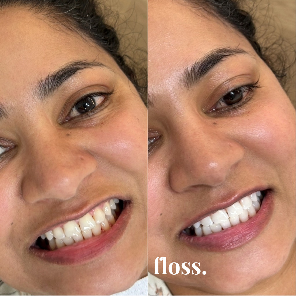 Close-up side-by-side photos of a woman smiling, showing her teeth before and after dental flossing. The word 'floss.' appears at the bottom.