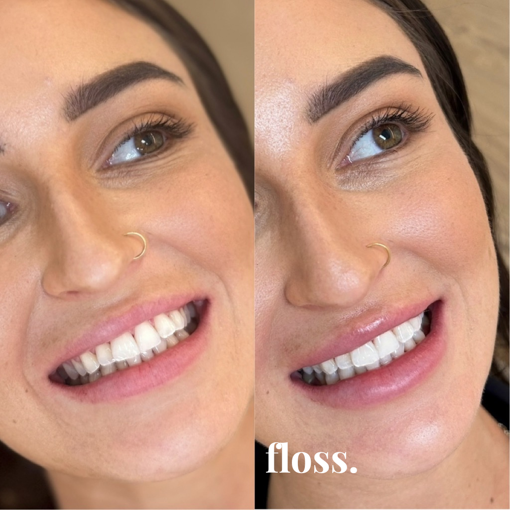 Close-up of a woman's face showing before and after dental flossing, with improved smile and cleaner teeth in the after photo.