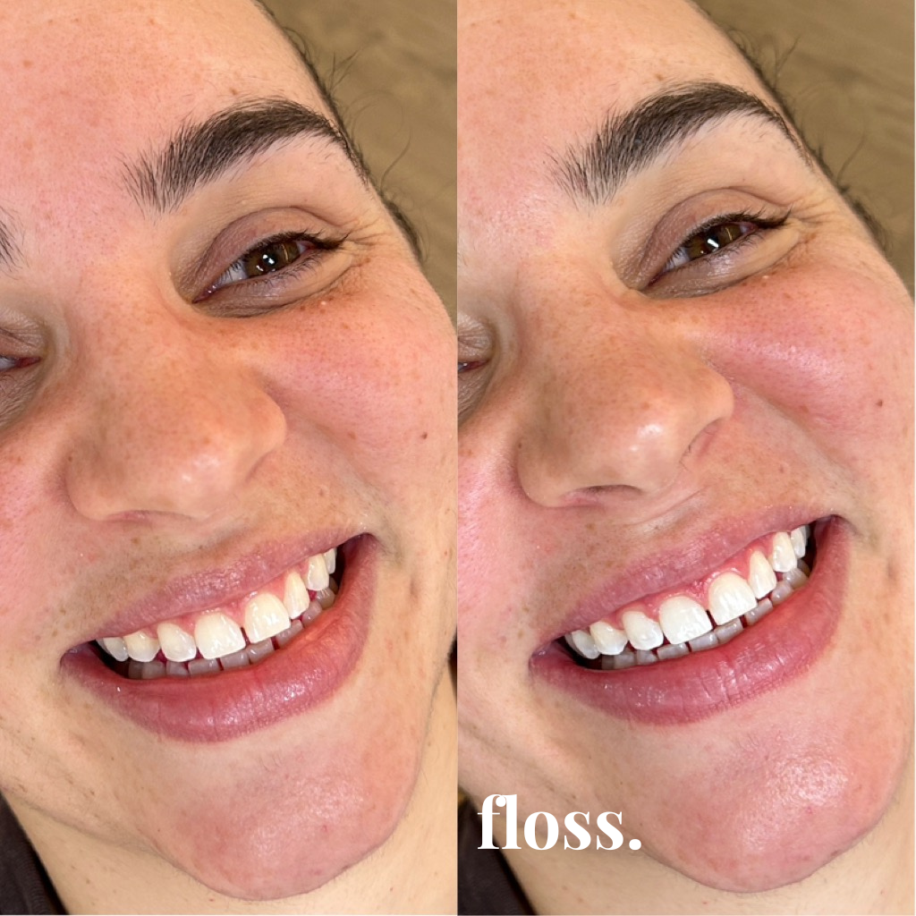 Close-up of a smiling woman's face showing her teeth before and after flossing, with the word "floss" at the bottom.